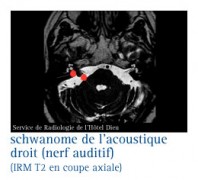 Tumeurs du système nerveux