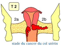 Cancer du col de l'utérus