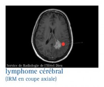 Tumeurs du système nerveux