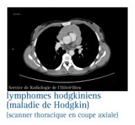 Le bilan d'extension d'une maladie de Hodgkin - InfoCancer