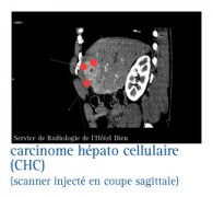 Cancers du foie (hépatocarcinome)