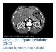 Cancers du foie (hépatocarcinome)