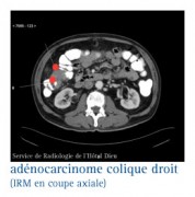 Cancer du côlon & du rectum (colorectal)