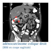 Cancer du côlon & du rectum (colorectal)