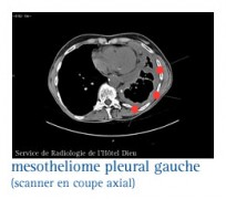 Mésothéliome pleural