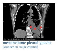 Mésothéliome pleural