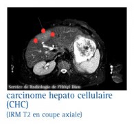 Quels examens pour diagnostiquer un cancer du foie (hépatome ...