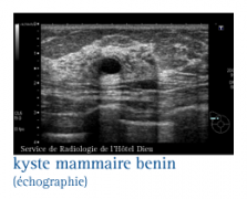 Les différents types de kystes mammaires - Symptômes, Diagnostic &  Traitements