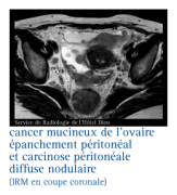 Cancer de l’ovaire