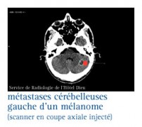 Les métastases cérébrales - InfoCancer