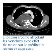 Sarcomes des tissus mous - Ostéosarcome