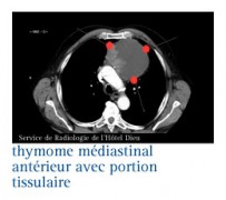 Le carcinome thymique - InfoCancer