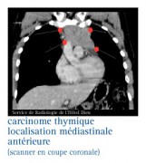 Cancer du thymus