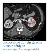 Les tumeurs bénignes du rein, kystes du rein, oncocytomes - Infocancer