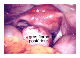 Les fibromes et l'endométriose - InfoCancer