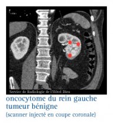 Les tumeurs bénignes du rein, kystes du rein, oncocytomes - Infocancer