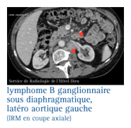 Lymphomes non hodgkiniens