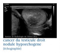 Cancer du testicule