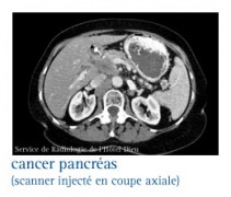 cancer du pancréas