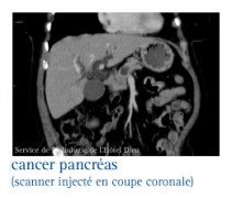 cancer du pancréas