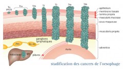 cancers de l'oesophage