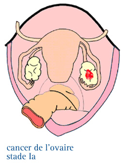 Cancer de l'ovaire