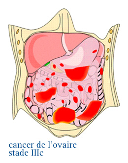 Cancer de l'ovaire