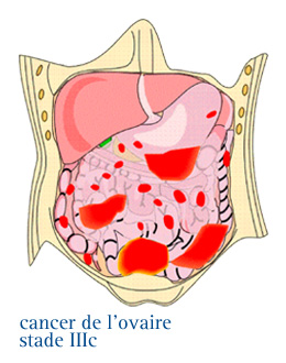 Quels sont les stades des cancer de l'ovaire ? InfoCancer