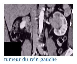 Cancer du rein