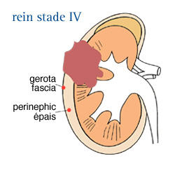 Cancer du rein