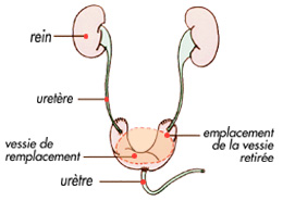 Cancers de la vessie