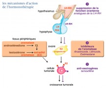 Cancer du sein controlatéral : symptômes, diagnostic et traitements